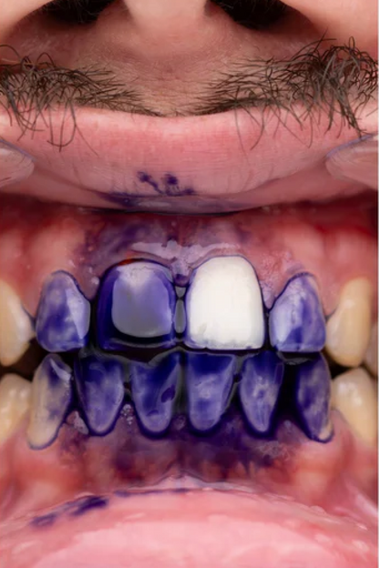 Sérum Clareador Dental Roxo V34: Neutralizador de Amarelo para Dentes Brilhantes e Sorriso Cativante