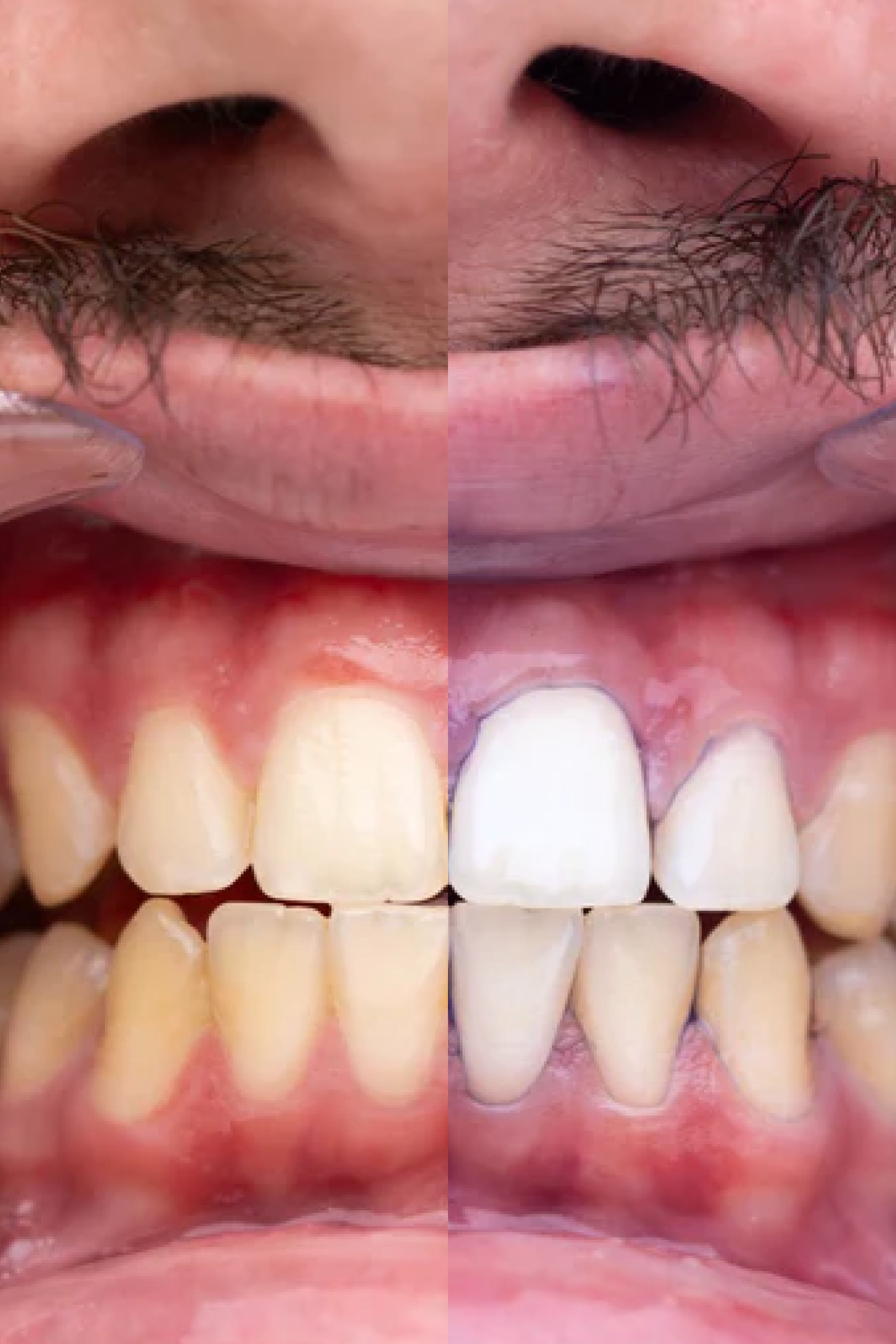 Sérum Clareador Dental Roxo V34: Neutralizador de Amarelo para Dentes Brilhantes e Sorriso Cativante